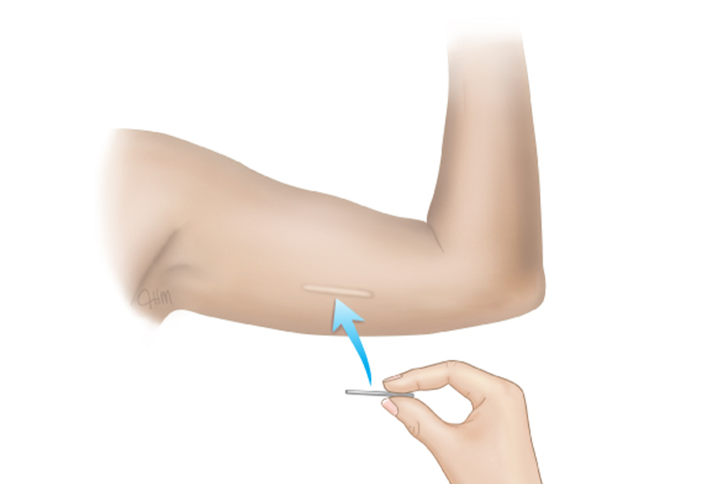 implant-nedir
